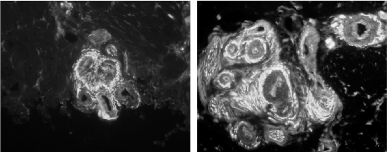 Fibromyalgia is Not All In Your Head, New Research Confirms